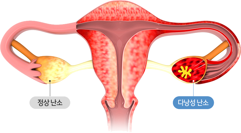 다낭성 난소 증후군이란?
