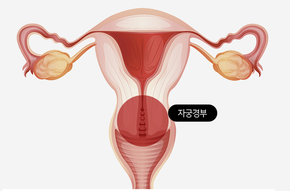 자궁경부암이란?
